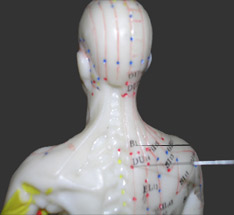 Acupuncture for every one