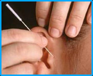 Acupuncture for Every one