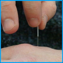 Acupuncture for every one
